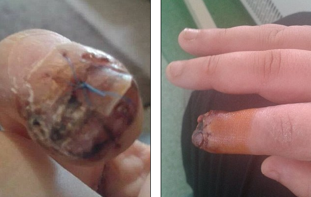 infection,faux,ongles,2