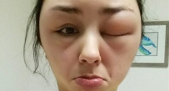 visage-gonfle-allergie-coloration-cheveux