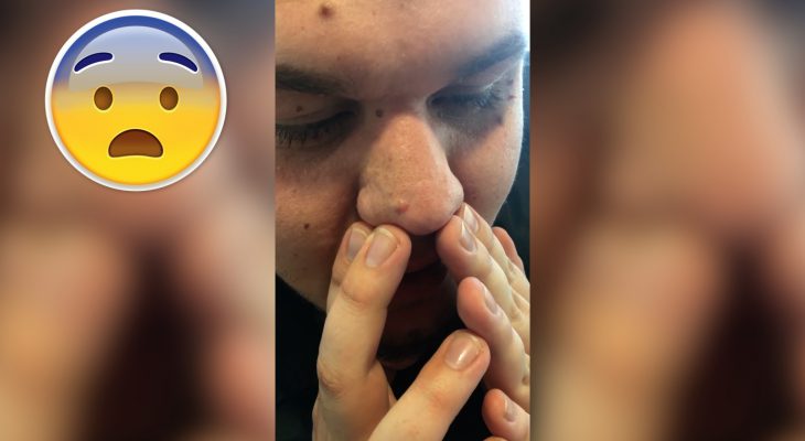 homme-presse-nez-boutons-noirs