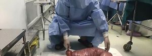 Constipé, les médecins lui retirent 13 kilos d’excréments de son corps (photos)